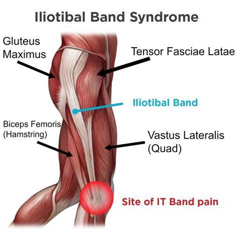 Iliotibial Band Syndrome (“Runner’s Knee”) | Complete Physio