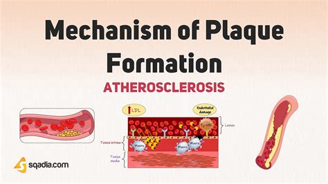 Atherosclerosis (Physiology)