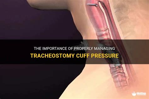 The Importance Of Properly Managing Tracheostomy Cuff Pressure | MedShun