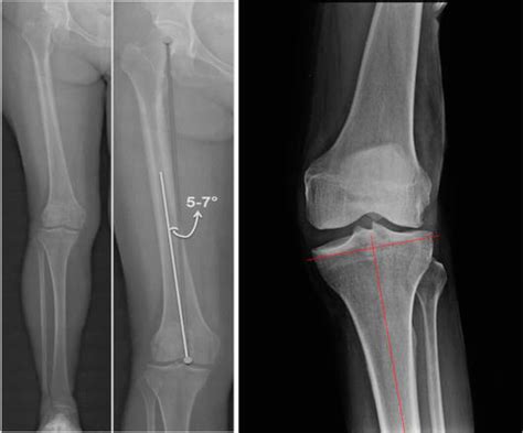 Valgus Deformity Correction in Total Knee Replacement: An Overview | IntechOpen