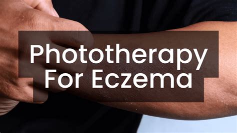 Phototherapy for Eczema – Care Lamps