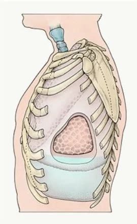 Pleurisy Treatment at best price in Jaipur | ID: 8898996033