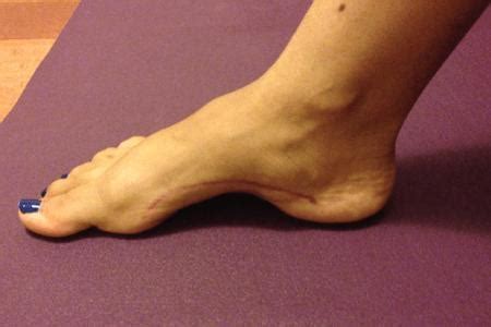 What Should You Watch For If You Have A High Arch Foot?: Foot and Ankle ...