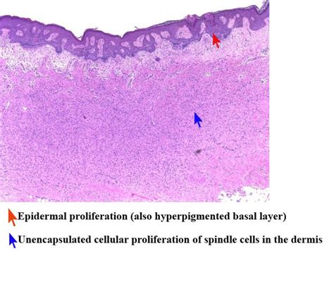 dermatofibroma histopathology | Medical science, Pathology, Dermis