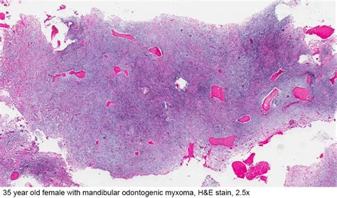 Pathology Outlines - Odontogenic myxoma / myxofibroma