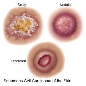 Squamous Cell Carcinoma (Discharge Care)