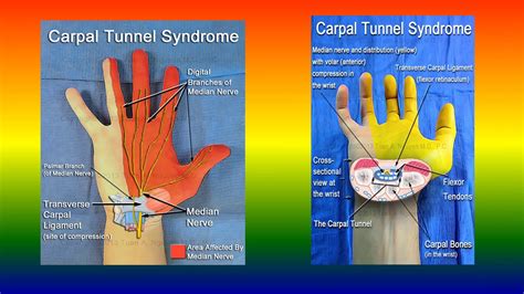 Acroparesthesia Syndrome - YouTube