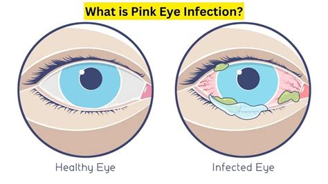 What is Pink Eye Infection? Why there is a rapid surge in the number of ...