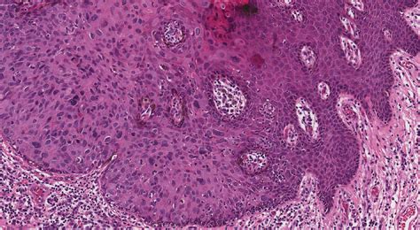 Vulva intraepitheliale Neoplasie (VIN) | MyPathologyReport.ca