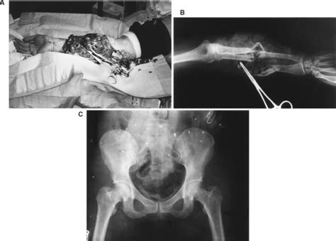 WOUND BALLISTICS: WHAT EVERY TRAUMA SURGEON SHOULD KNOW | Clinical Gate