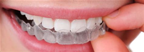 clear retainers macomb mi | Kubicki Orthodontics