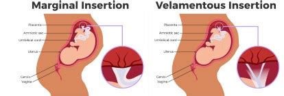 Velamentous Cord Insertion Ultrasound