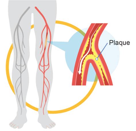 Understanding Peripheral Vascular Disease: Causes, Symptoms, and Treatment