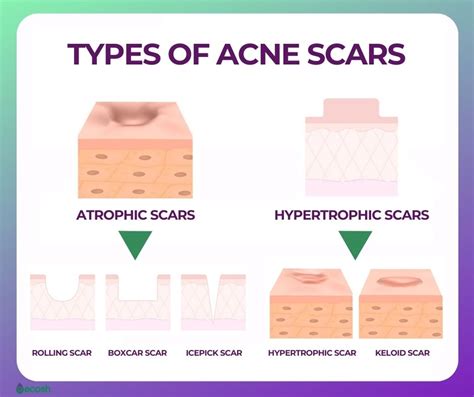 ACNE - Symptoms, Causes, Complications, and Treatment - Ecosh