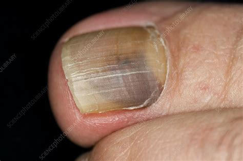 Fungal infection of the toenail - Stock Image C007/2699 - Science Photo ...