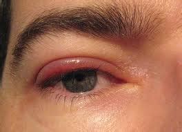 How To Treat EyeLid Mites ~ EyeLash Demodex Mites