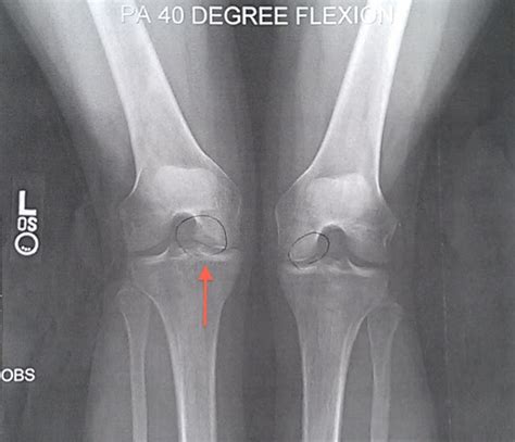 OT With a Bad Knee: Osteochondritis Dissecans (OCD of the Knee)