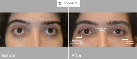 Almond Eye Surgery Before and After Gallery | Taban MD