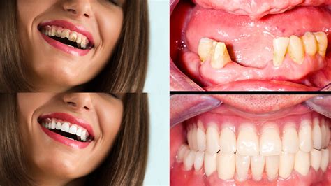 Total Mouth Reconstruction Services in Los Angeles - West Hollywood ...