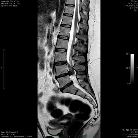 Hernia Discal Lumbar - Neurocirugía Barcelona