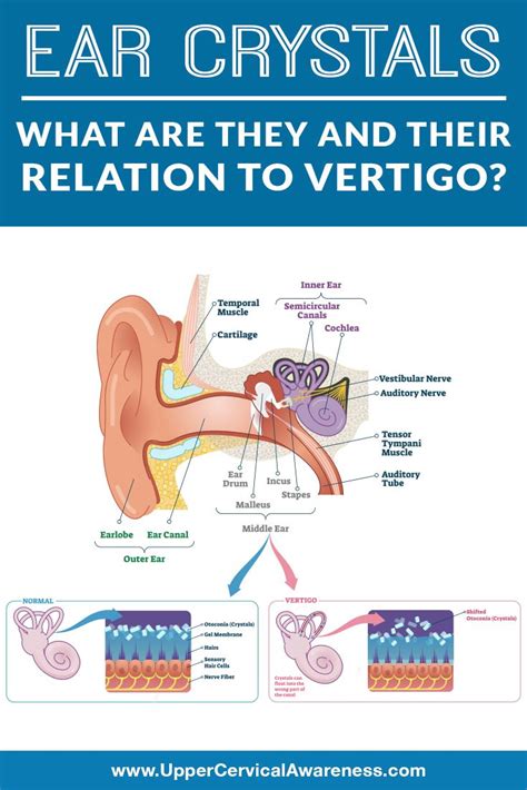 Ear Crystals: What Are They and Their Relation to Vertigo? - Upper Cervical Awareness | Vertigo ...