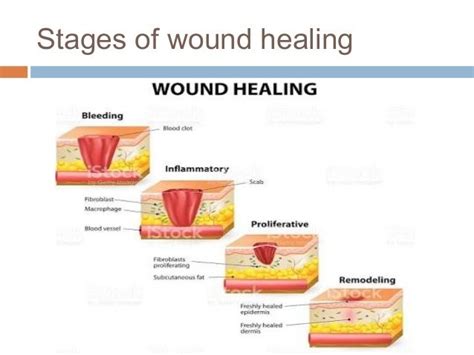 Surgical Wound Healing Stages