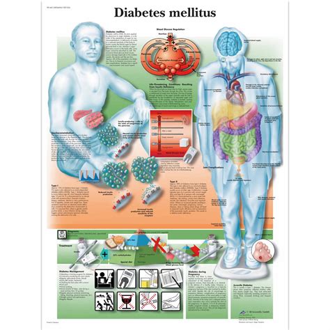 Diabetes Mellitus Chart - SEM Trainers