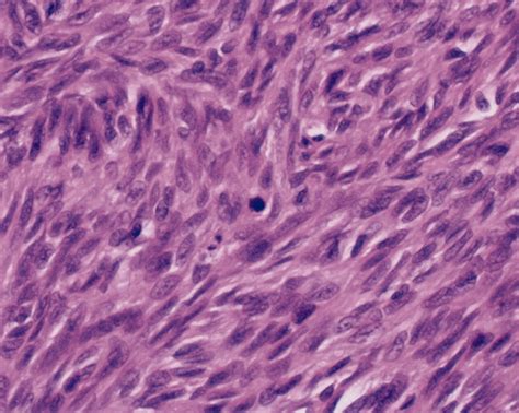 Leiomyosarcoma - Causes, Symptoms, Treatment, Prognosis and Survival Rate