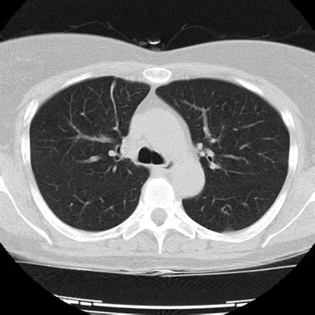 minimal bibasilar atelectasis on ct scan