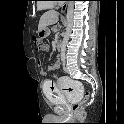 Urinary Bladder Diverticulum: A Single-Center Experience in the Management of Refractory Lower ...