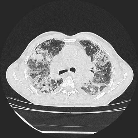 Hypersensitivity Pneumonitis Ct Scan