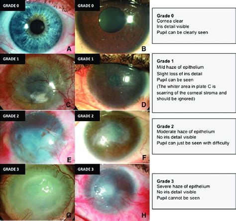 Standardized grading plate used to grade corneal epithelial haze as... | Download Scientific Diagram