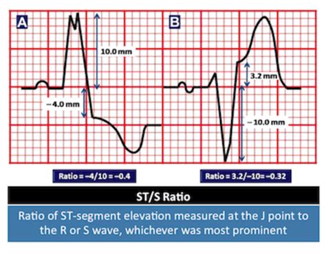 Validation of the Modified Sgarbossa Criteria – Core EM