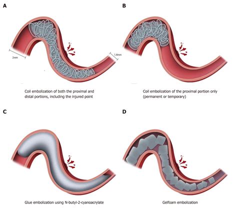 Gelfoam embolization for distal, medium vessel injury during mechanical ...