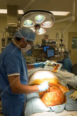 Scrotal hernia surgery - Stock Image - C033/6063 - Science Photo Library