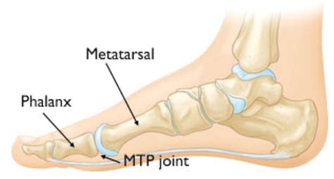 Hallux Rigidus - Liverpool Foot Centre