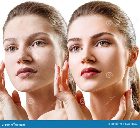 Woman with Acne before and after Treatment and Make-up. Stock Photo ...