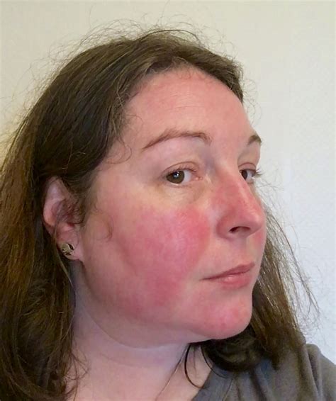 Lupus can cause a red butterfly-shaped rash across the nose and cheeks ...