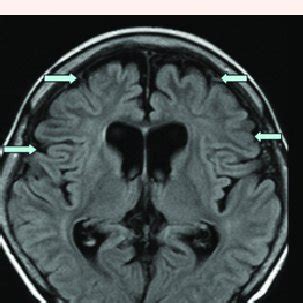 Axial view of the MRI brain (FLAIR) showing diffuse atrophy of the ...