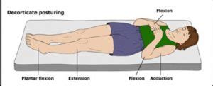 HOW TO ASSESS GLASGOW COMA SCALE (GCS) IN ADULTS AND CHILDREN? - Intensive Care Hotline