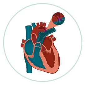 Patent Ductus Arteriosus Symptoms | PharmEasy