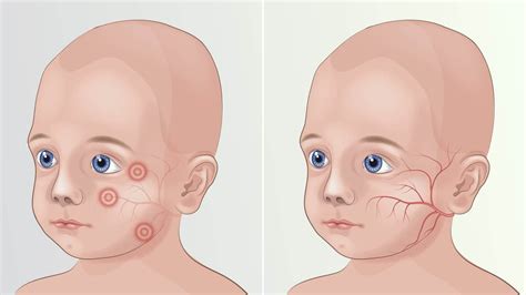 Increasing Occurrences of Phenylketonuria to drive the Phenylketonuria ...