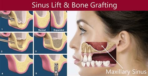 Direct & Indirect Sinus Lift Surgery for Tooth implants Cost