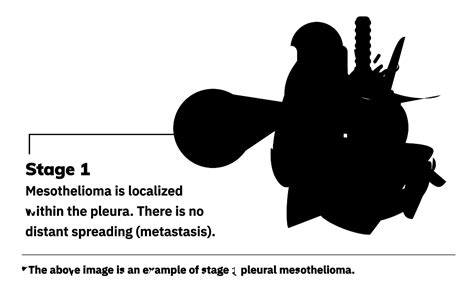 4 Mesothelioma Stages | Staging Systems & Treatment by Stage