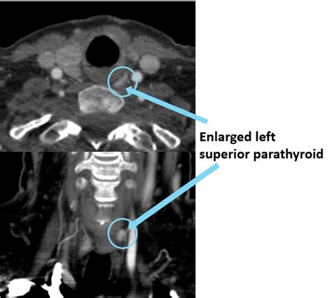 Parathyroid Imaging and Ultrasounds | Saint John’s Cancer Institute