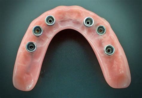 Fixed Implant Retained Hybrid Dentures - ProCare Denture Clinic ...