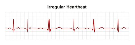 What Does An Abnormal ECG Mean? - Capital Heart Centre