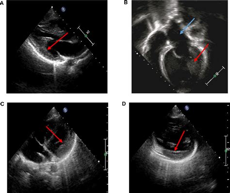 Echocardiography in HCM probands. (A) Echocardiography of a proband:... | Download Scientific ...