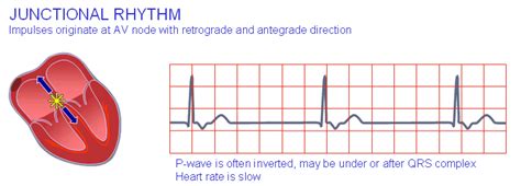 2.H Junctional rhythm. | Download Scientific Diagram