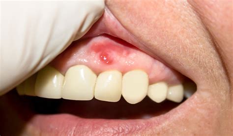 Gum Infections at London Baker Street Gum Infections